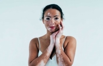 Vamos falar sobre vitiligo?